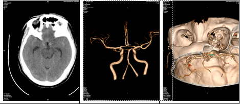 闭孔动脉CT图片